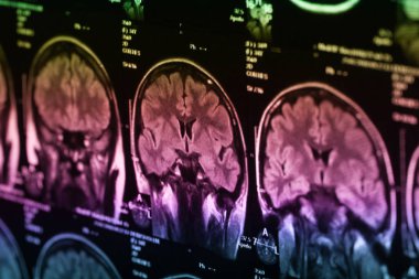 İnsan beyninin, portre resim tıbbi x-ray