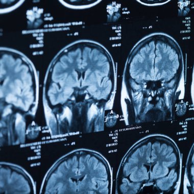İnsan beyninin, portre resim tıbbi x-ray