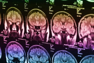 İnsan beyninin, portre resim tıbbi x-ray