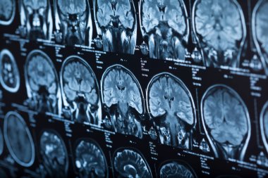 Medical x-ray of human brain, closeup image clipart