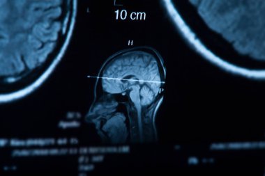 İnsan beyninin, portre resim tıbbi x-ray