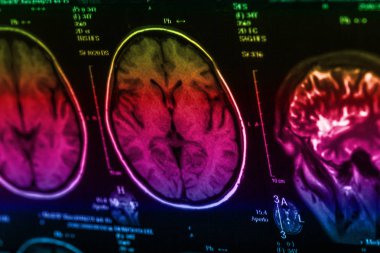 İnsan beyninin, portre resim tıbbi x-ray