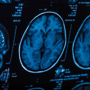 İnsan beyninin, portre resim tıbbi x-ray