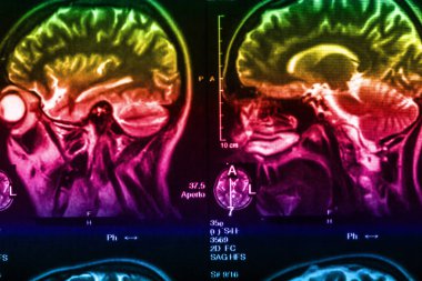 İnsan beyninin, portre resim tıbbi x-ray