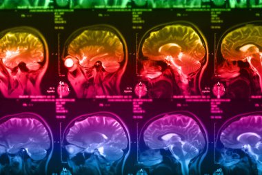 İnsan beyninin, portre resim tıbbi x-ray