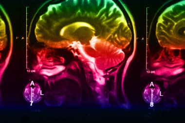 İnsan beyninin, portre resim tıbbi x-ray