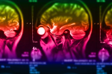 İnsan beyninin, portre resim tıbbi x-ray