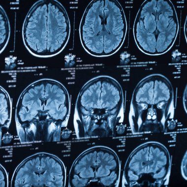 İnsan beyninin, portre resim tıbbi x-ray