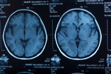 İnsan beyninin, portre resim tıbbi x-ray