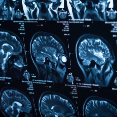 İnsan beyninin, portre resim tıbbi x-ray