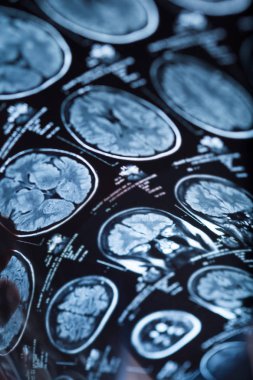 İnsan beyninin, portre resim tıbbi x-ray