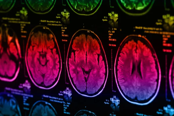 Lékařských Rentgenových Lidského Mozku Detailní Snímky — Stock fotografie