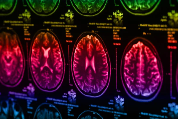 Lékařských Rentgenových Lidského Mozku Detailní Snímky — Stock fotografie