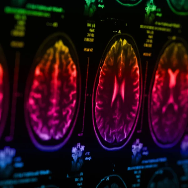 İnsan beyninin, portre resim tıbbi x-ray