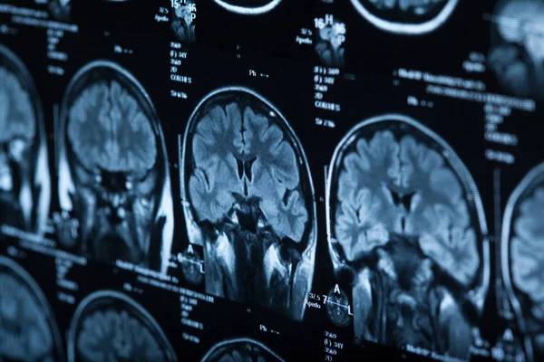 Ιατρική Ακτινογραφία Του Ανθρώπινου Εγκεφάλου Closeup Εικόνας — Φωτογραφία Αρχείου