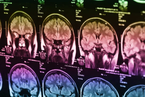 İnsan beyninin, portre resim tıbbi x-ray