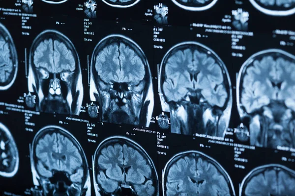 Medical Ray Human Brain Closeup Image — Stock Photo, Image