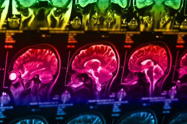 İnsan beyninin, portre resim tıbbi x-ray