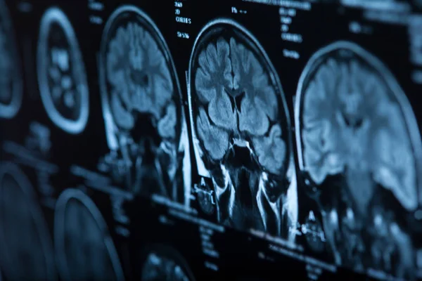 Medical Ray Human Brain Closeup Image — Stock Photo, Image