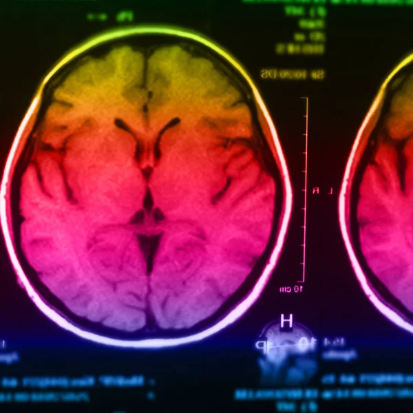 Medische Ray Van Menselijke Hersenen Close Beeld — Stockfoto