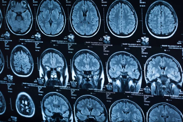 Medical Ray Human Brain Closeup Image — Stock Photo, Image