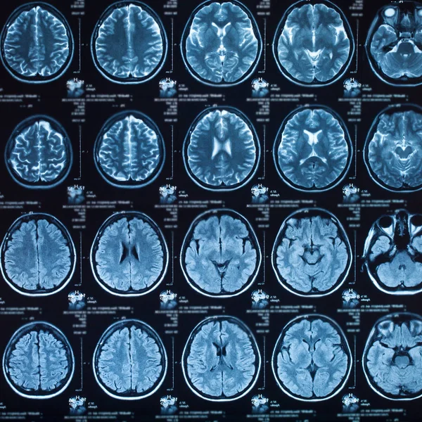 Medical x-ray of human brain, closeup image