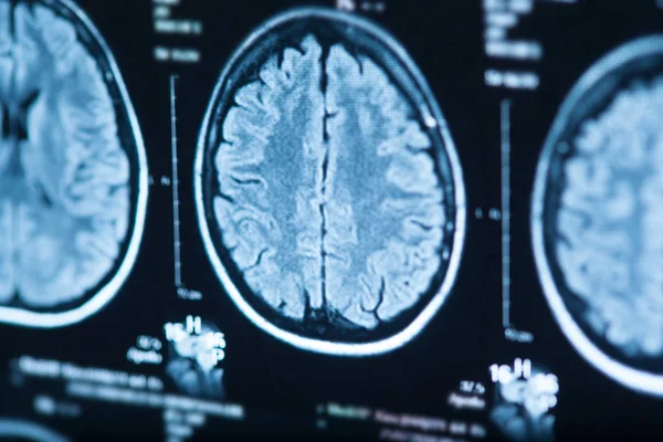 Medical Ray Human Brain Closeup Image — Stock Photo, Image