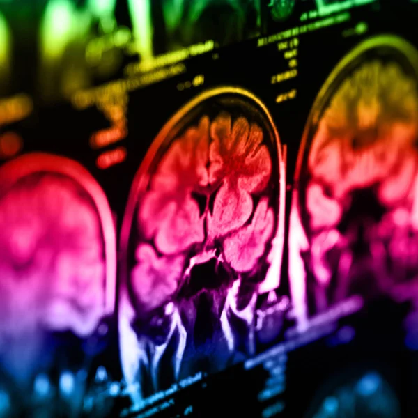Radiografia Médica Cérebro Humano Imagem Close — Fotografia de Stock