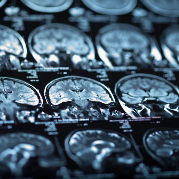 Medical Ray Human Brain Closeup Image — Stock Photo, Image