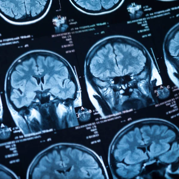 Medical x-ray of human brain, closeup image