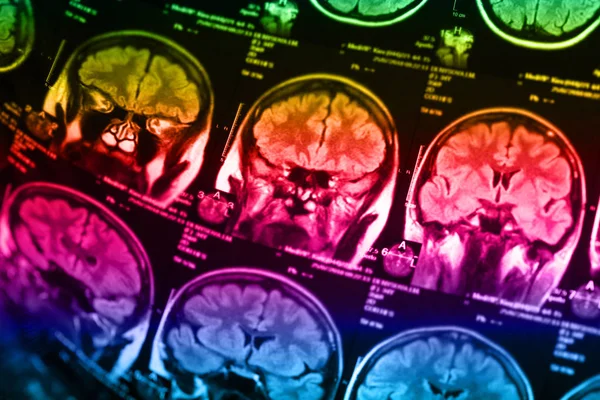 İnsan beyninin, portre resim tıbbi x-ray