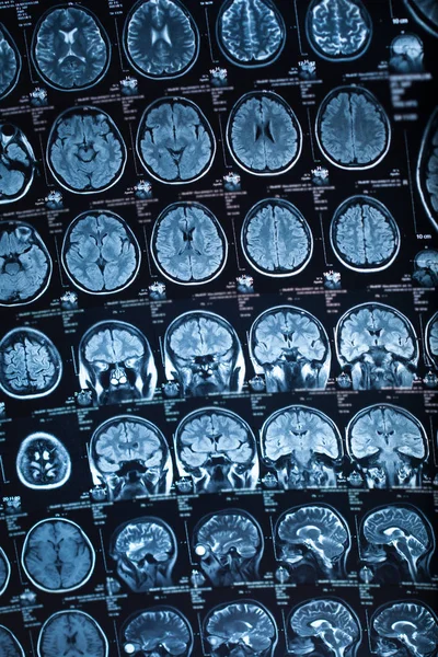 Medyczne Prześwietlenie Ludzkiego Mózgu Zbliżenie Obrazu — Zdjęcie stockowe