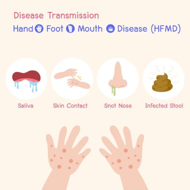 Hastalık İletim Hastalık virüs bebek Çocuklar enfekte bir Blister El Ayak Ağız Hastalığı var, Yağmur mevsiminde Hfmd, Tıbbi Sağlık kavramı, tükürük, burun snot, Cilt temas, Enfekte dışkı.