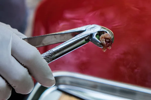 Removing Caries Hand Wearing Rubber Dental Glove Holding Dental Forceps — Stock Photo, Image