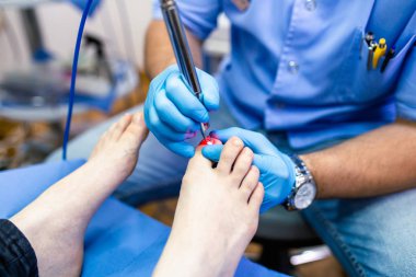 Laser tırnak tedavisi kliniğinde ayak lazeriyle ayak mantarı tedavisi..