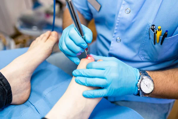 Tratamento Fungos Unha Com Laser Clínica Terapia Unhas Laser — Fotografia de Stock