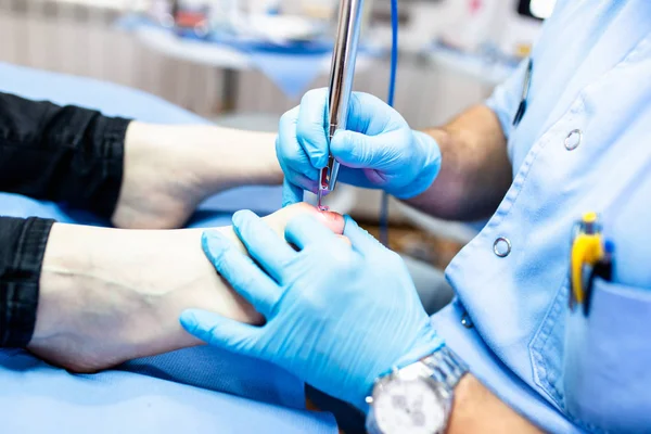 Tratamento Fungos Unha Com Laser Clínica Terapia Unhas Laser — Fotografia de Stock