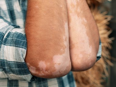 Vitiligo 'su olan bir adamın kolları..