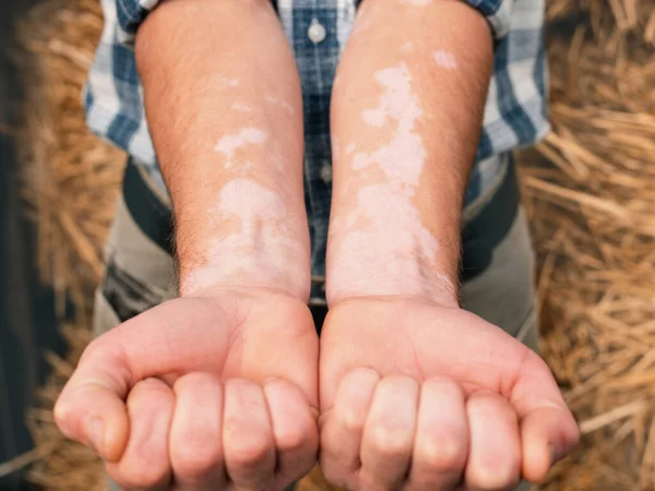 Man shows hands with skin affected by vitiligo.