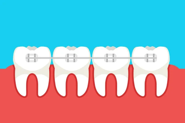 Human Teeth Metal Braces Blue Background — Stock Vector