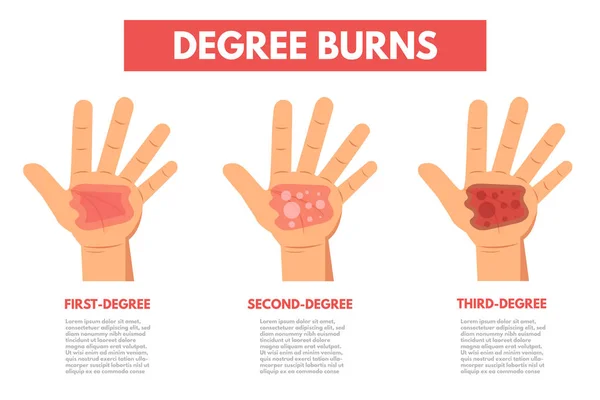 Poster Degree Burns Skin — Stock Vector