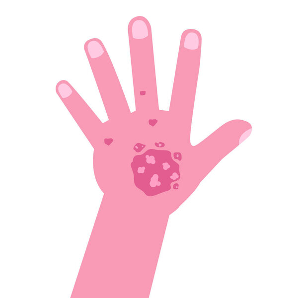 Hand with psoriasis or Eczema. Vector illustration.