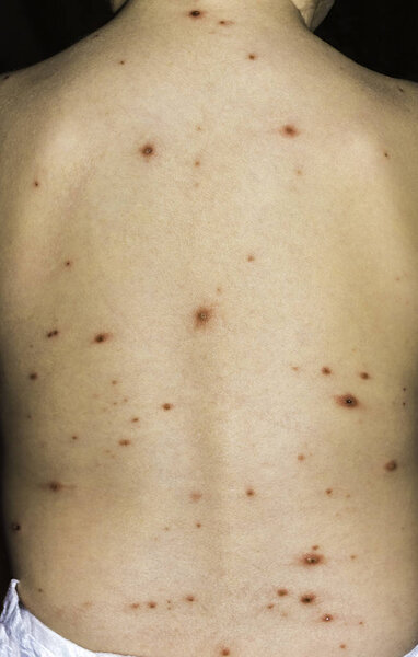 Varicella Virus or Chicken Pox on Baby's Back.