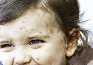 Varicella Virus or Chicken Pox on Babys Face clipart