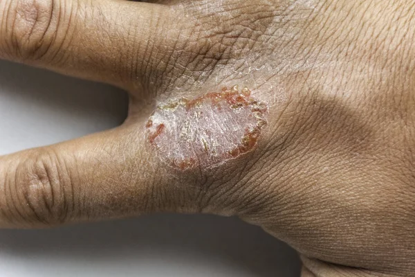 Mão com Dermatite Atópica Eczema Psoríase Vulgar — Fotografia de Stock