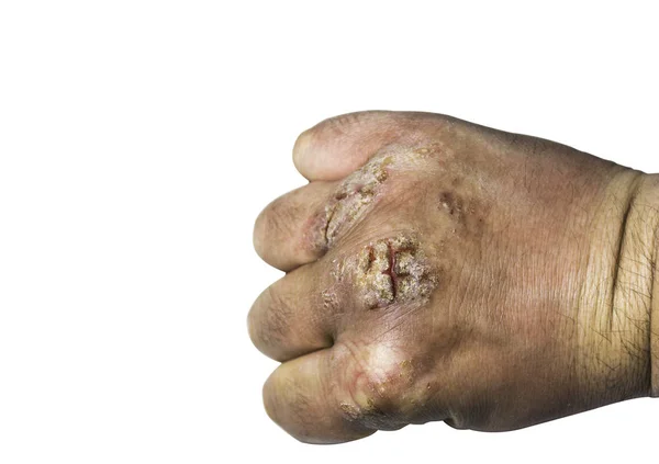 Hand med atopisk dermatit, eksem, psoriasis vulgaris! — Stockfoto