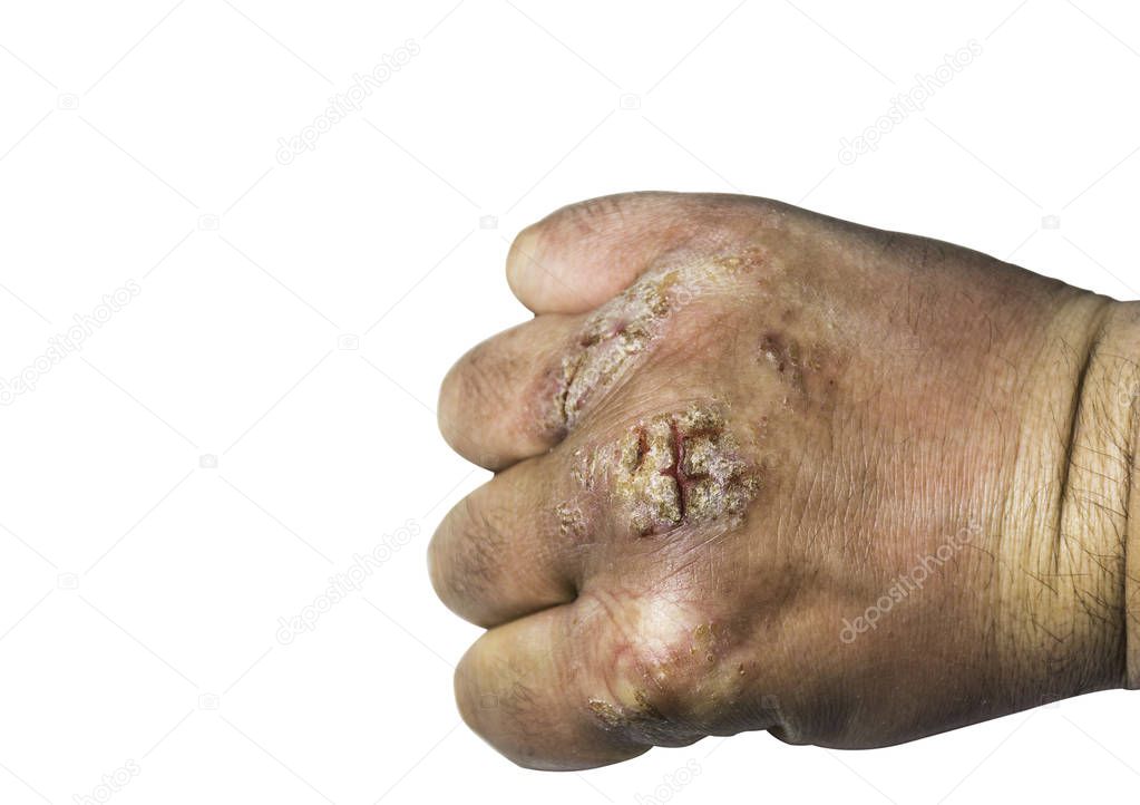 Hand With Atopic Dermatitis, Eczema, Psoriasis Vulgaris!