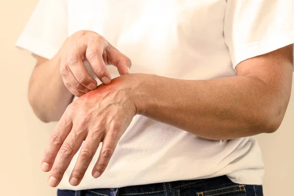 Vrouw Scratching een jeuk. Gevoelige huid, voedselallergie symptomen, irritatie. — Stockfoto