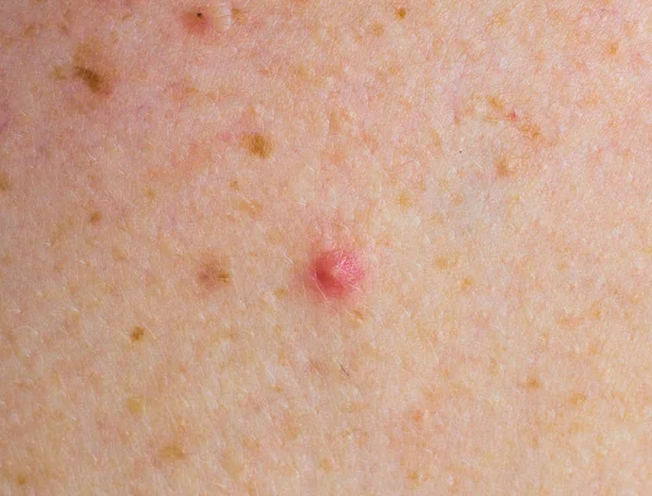 Röd finne på ansikte makro, abscess och acne — Stockfoto