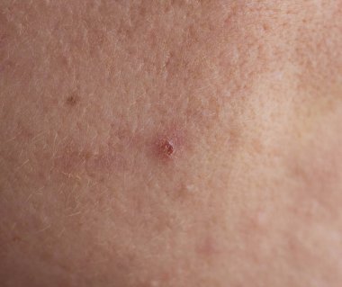 Kırmızı sivilce yüz makro, apse, fistül ve akne